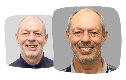 Реабилитация пациента 57 лет с использованием концепции All-on-4® с бескаркасным протезом за 1 день