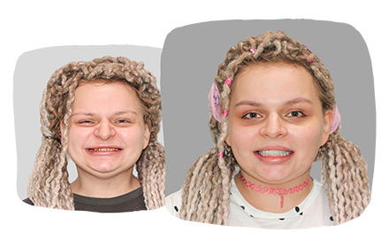 Реабилитация пациентки 27 лет с аутоиммунным заболеванием с помощью имплантов Zygoma