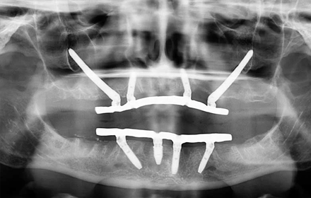 Сложная реабилитация пациента с атрофией костной ткани с применением имплантов Zygoma