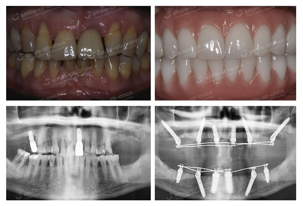 Полное восстановление зубов на верхней челюсти по протоколу all-on-6 V-II-V с транссинусальной установкой имплантов