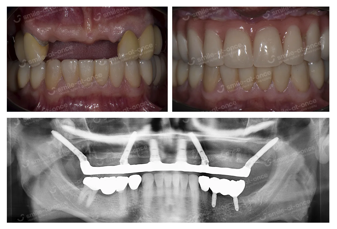 Имплантация all-on-6 V-II-V с установкой имплантов транссинусально для верхней челюсти
