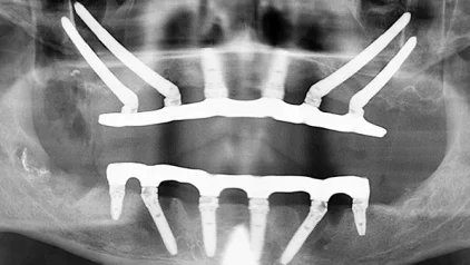 Реабилитация верхней челюсти с применением четырех скуловых имплантатов Zygoma